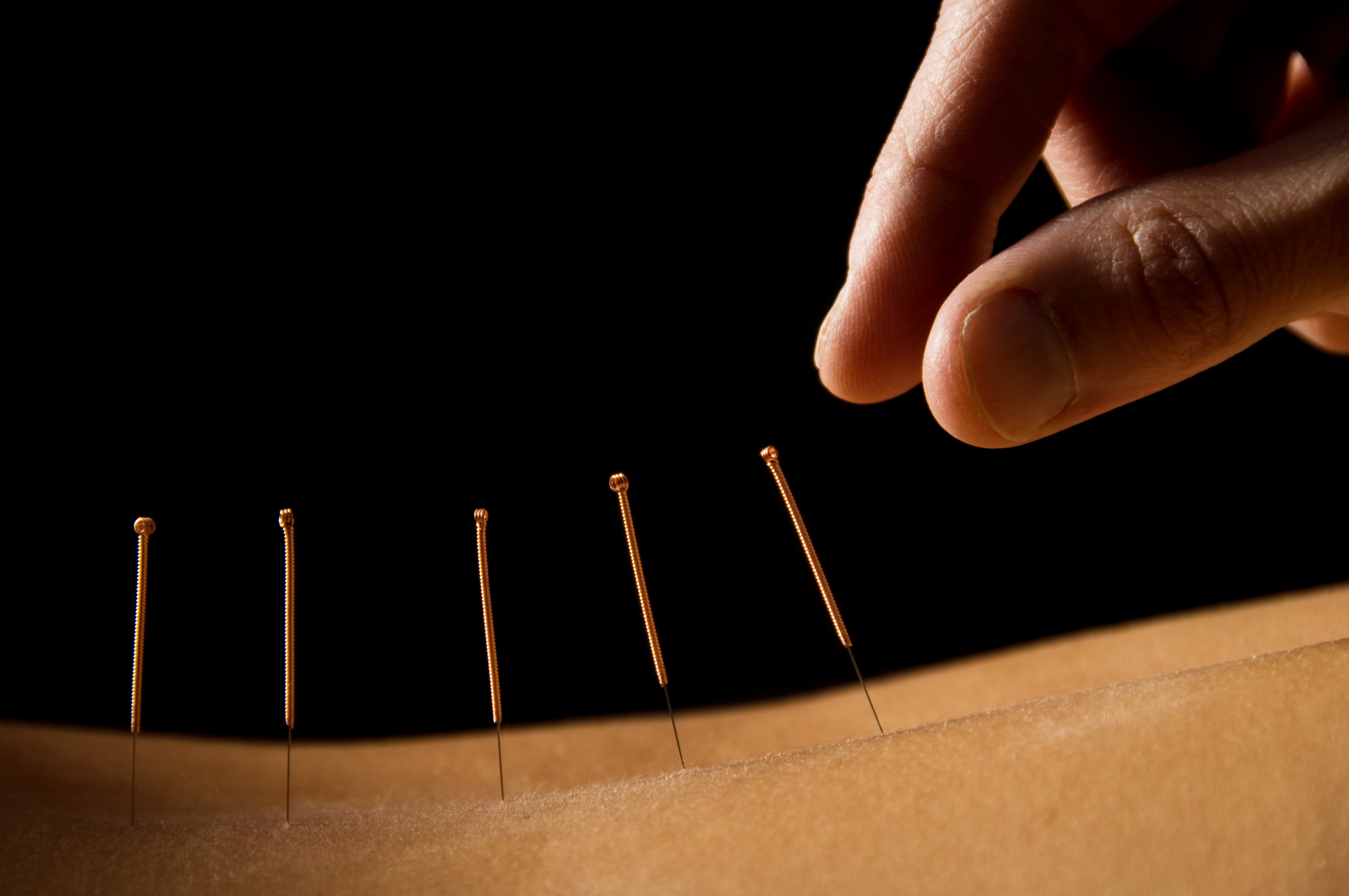 Removing Acupuncture Needles